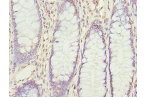 Immunohistochemistry of paraffin-embedded human colon cancer using ABIN7168204 at dilution of 1:100 (RPS6KL1 抗体  (AA 1-130))