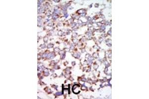 Formalin-fixed and paraffin-embedded human cancer tissue reacted with the primary antibody, which was peroxidase-conjugated to the secondary antibody, followed by AEC staining. (TR4 抗体  (C-Term))