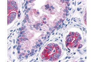 Anti-TNIK antibody IHC of human Prostate, Carcinoma. (TNIK 抗体  (Internal Region))