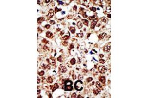 Formalin-fixed and paraffin-embedded human cancer tissue reacted with FDFT1 polyclonal antibody  , which was peroxidase-conjugated to the secondary antibody, followed by DAB staining . (FDFT1 抗体  (Internal Region))