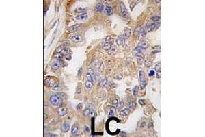 Formalin-fixed and paraffin-embedded human lung carcinoma tissue reacted with AGR2 antibody (Center), which was peroxidase-conjugated to the secondary antibody, followed by DAB staining. (AGR2 抗体  (AA 95-124))