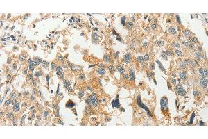 Immunohistochemistry of paraffin-embedded Human esophagus cancer tissue using SLC11A2 Polyclonal Antibody at dilution 1:50 (SLC11A2 抗体)