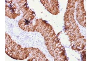 Formalin-fixed, paraffin-embedded human Rectal Mass stained with EpCAM Mouse Recombinant Monoclonal Antibody (rEGP40/1372). (Recombinant EpCAM 抗体  (Extracellular Domain))