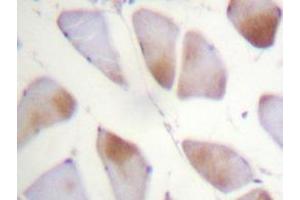 Immunohistochemistry analyzes of Crystallin-αB antibody in paraffin-embedded human breast carcinoma tissue. (CRYAB 抗体)