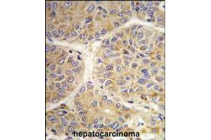 Formalin-fixed and paraffin-embedded human hepatocarcinoma tissue reacted with the AASS antibody , which was peroxidase-conjugated to the secondary antibody, followed by DAB staining. (AASS 抗体  (AA 264-294))