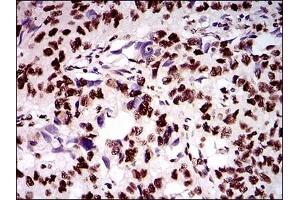 Immunohistochemical analysis of paraffin-embedded human esophageal cancer tissues using KIAA1967 mouse mAb with DAB staining. (CCAR2 抗体)