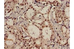 Immunohistochemistry analysis of human breast cancer using ABIN7159096 at dilution of 1:100 (MDC1 抗体  (AA 1892-2082))