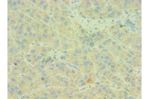 Immunohistochemistry of paraffin-embedded human liver cancer using ABIN7146168 at dilution of 1:100 (C4BPB 抗体  (AA 18-252))