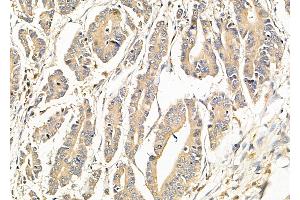 ABIN6265478 and ABIN6279868 at 1/100 staining Human pancreatic cancer by IHC-P. (TBC1D2 抗体  (N-Term))