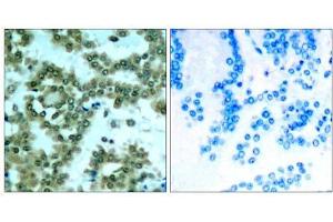 Immunohistochemical analysis of paraffin-embedded human lung carcinoma tissue, using PKCθ (phospho- Ser676) antibody (E011297). (PKC theta 抗体  (pSer676))