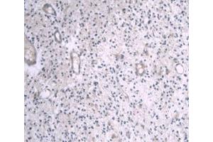 DAB staining on IHC-P; Samples: Human Glioma Tissue (APOA1 抗体  (AA 122-267))