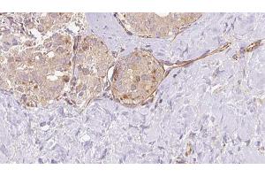 ABIN6273326 at 1/100 staining Human thyroid cancer tissue by IHC-P. (SUOX 抗体  (Internal Region))