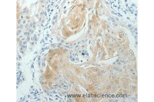 Immunohistochemistry of Human cervical cancer using RNF126 Polyclonal Antibody at dilution of 1:70 (RNF126 抗体)