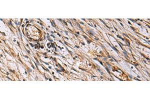 Immunohistochemistry of paraffin-embedded Human colorectal cancer tissue using ECM1 Polyclonal Antibody at dilution of 1:25(x200) (ECM1 抗体)