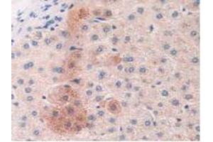 Detection of MASP2 in Human Liver Cancer Tissue using Polyclonal Antibody to Mannose Associated Serine Protease 2 (MASP2) (Mannose Associated Serine Protease 2 (AA 445-683) 抗体)