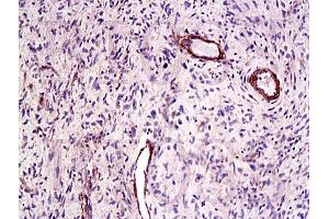 Formalin-fixed and paraffin embedded human laryngeal cancer labeled Anti-CTGF Polyclonal Antibody, Unconjugated (ABIN672636) at 1:200, followed by conjugation to the secondary antibody and DAB staining (CTGF 抗体  (AA 221-349))