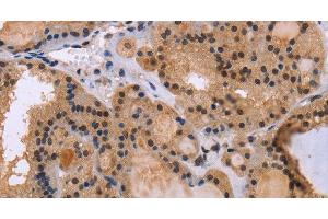 Immunohistochemistry of paraffin-embedded Human thyroid cancer tissue using KIF25 Polyclonal Antibody at dilution 1:40 (KIF25 抗体)