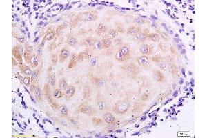 Formalin-fixed and paraffin embedded human oral squamous cell carcinoma labeled with Anti- MUC4 Polyclonal Antibody, Unconjugated  at 1:200 followed by conjugation to the secondary antibody and DAB staining (MUC4 抗体  (AA 1501-1613))