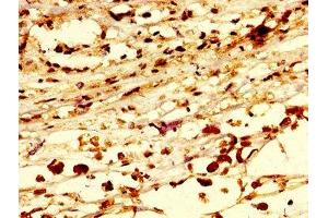 IHC image of ABIN7168252 diluted at 1:300 and staining in paraffin-embedded human melanoma performed on a Leica BondTM system. (RNF219 抗体  (AA 257-465))