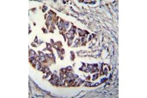Formalin fixed, paraffin embedded human breast carcinoma stained with RAD9A Antibody  followed by peroxidase conjugation of the secondary antibody and DAB staining. (RAD9A 抗体)