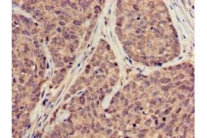 Immunohistochemistry of paraffin-embedded human ovarian cancer using ABIN7169889 at dilution of 1:100 (SUMO3 抗体  (AA 1-92))
