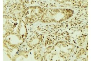 ABIN6267095 at 1/100 staining Human breast cancer tissue by IHC-P. (BAP1 抗体  (pSer592))