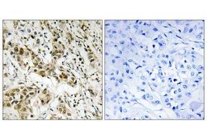 Immunohistochemistry analysis of paraffin-embedded human breast carcinoma tissue using CtBP1 (epitope around residue 422) antibody. (CTBP1 抗体  (Ser422))