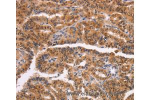 Immunohistochemistry of Human liver cancer using NCAPG2 Polyclonal Antibody at dilution of 1:50 (NCAPG2 抗体)