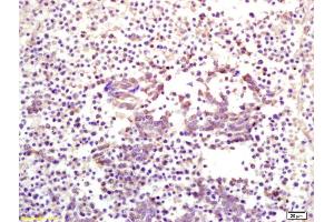 Formalin-fixed and paraffin embedded human lung carcinoma labeled with Anti CKIP-1 Polyclonal Antibody, Unconjugated (ABIN675039) at 1:200 followed by conjugation to the secondary antibody and DAB staining (PLEKHO1 抗体  (AA 51-170))