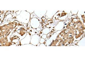 Immunohistochemistry of paraffin-embedded Human breast cancer tissue using UBE2Z Polyclonal Antibody at dilution of 1:35(x200) (UBE2Z 抗体)