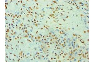 Immunohistochemistry of paraffin-embedded human breast cancer using ABIN7175904 at dilution of 1:100 (XRCC5 抗体  (AA 543-732))