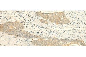 Immunohistochemistry of paraffin-embedded Human esophagus cancer tissue using MPV17 Polyclonal Antibody at dilution of 1:50(x200) (MPV17 抗体)