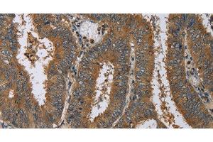 Immunohistochemistry of paraffin-embedded Human colon cancer using HSP40-4 Polyclonal Antibody at dilution of 1:60 (HSP40-4 抗体)