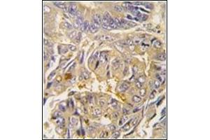 Formalin-fixed and paraffin-embedded human colon carcinoma tissue reacted with Autophagy APG16L Antibody , which was peroxidase-conjugated to the secondary antibody, followed by DAB staining.