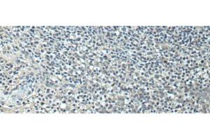 Immunohistochemistry of paraffin-embedded Human tonsil tissue using SLC35F6 Polyclonal Antibody at dilution of 1:95(x200) (SLC35F6 抗体)