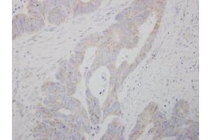 IHC-P Image COMT antibody detects COMT protein at cytosol on human colon carcinoma by immunohistochemical analysis. (COMT 抗体)