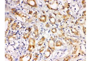 Anti- LOXL1 Picoband antibody, IHC(P) IHC(P): Human Prostatic Cancer Tissue (LOXL1 抗体  (C-Term))