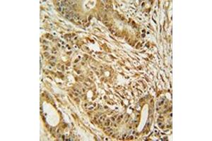 Immunohistochemistry analysis in formalin fixed and paraffin embedded human colon carcinoma reacted with MCM2 Antibody (C-term) followed which was peroxidase conjugated to the secondary antibody and followed by DAB staining. (MCM2 抗体  (C-Term))