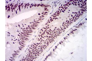 Immunohistochemical analysis of paraffin-embedded rectum cancer tissues using KMT2D mouse mAb with DAB staining. (Lysine (K)-Specific Methyltransferase 2B (KMT2B) (AA 445-599) 抗体)