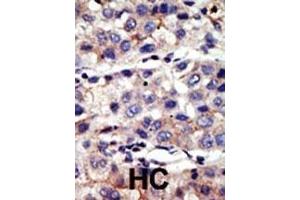 Formalin-fixed and paraffin-embedded human cancer tissue reacted with the primary antibody, which was peroxidase-conjugated to the secondary antibody, followed by AEC staining. (CBX4 抗体  (N-Term))