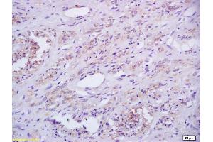 Formalin-fixed and paraffin embedded human cervical carcinoma labeled with Rabbit Anti Phospho-IRAK1 (Thr387) Polyclonal Antibody, Unconjugated (ABIN742673) at 1:200 followed by conjugation to the secondary antibody and DAB staining (IRAK1 抗体  (pThr387))