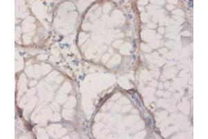 Immunohistochemistry of paraffin-embedded human colon cancer using ABIN7142468 at dilution of 1:20 (HPD 抗体  (AA 2-393))