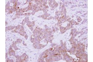 IHC-P Image Immunohistochemical analysis of paraffin-embedded human breast cancer, using CPNE6, antibody at 1:250 dilution. (CPNE6 抗体)