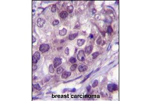 NR3C1 Antibody (Center) (ABIN651659 and ABIN2840347) immunohistochemistry analysis in formalin fixed and paraffin embedded human breast carcinoma followed by peroxidase conjugation of the secondary antibody and DAB staining. (Glucocorticoid Receptor 抗体  (AA 236-262))