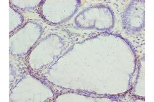 Immunohistochemistry of paraffin-embedded human colon cancer using ABIN7153655 at dilution of 1:100 (MLZE 抗体  (AA 1-508))