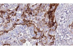 ABIN6276996 at 1/100 staining Human urothelial cancer tissue by IHC-P. (ACVR2A 抗体  (Internal Region))