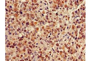 Immunohistochemistry of paraffin-embedded human glioma using ABIN7147705 at dilution of 1:100 (CBX5 抗体  (AA 1-191))