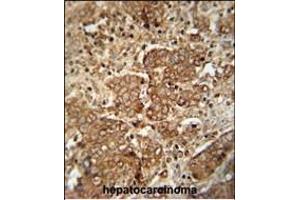 CS antibody (C-term) 10677b immunohistochemistry analysis in formalin fixed and paraffin embedded human hepatocarcinoma followed by peroxidase conjugation of the secondary antibody and DAB staining. (APCS 抗体  (C-Term))