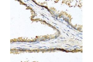 Immunohistochemistry of paraffin-embedded Human prostate using SOST Polyclonal Antibody at dilution of 1:100 (40x lens). (Sclerostin 抗体)