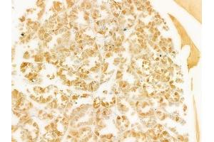ABIN6263190 and ABIN6279525 at 1/100 staining human renal cell carcinoma by IHC-P.